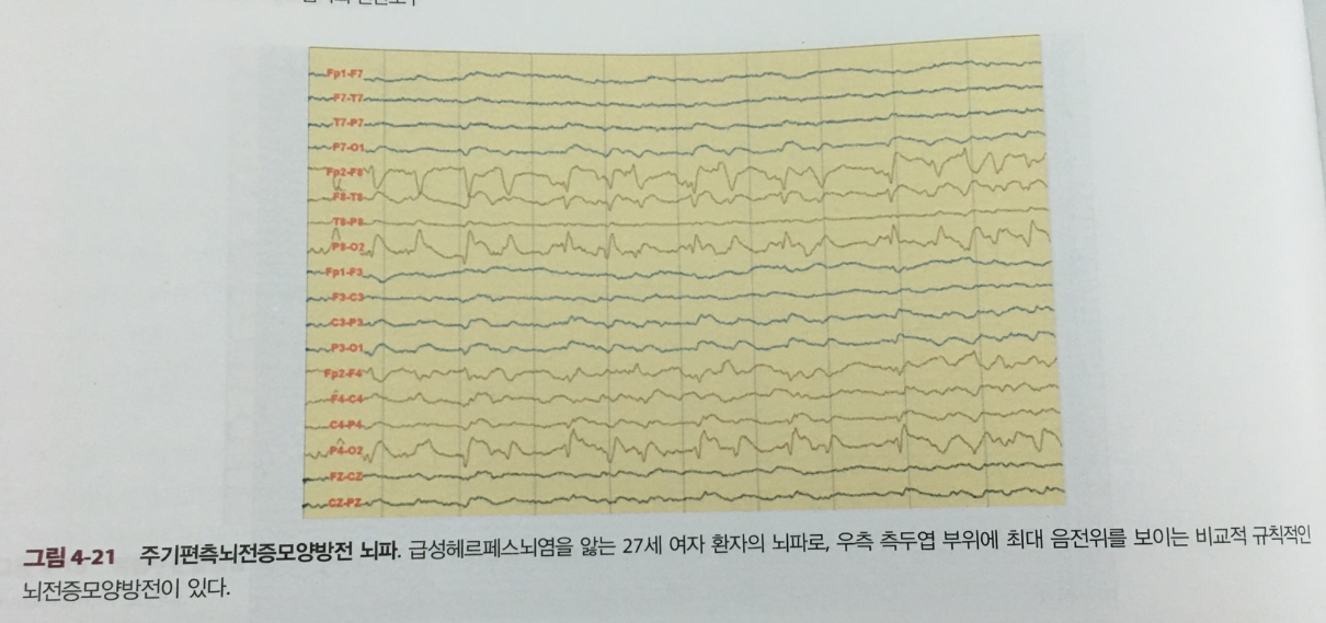 PLEDs 뇌파 예시 1