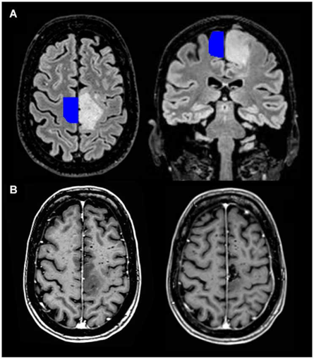 EEG electrode placement