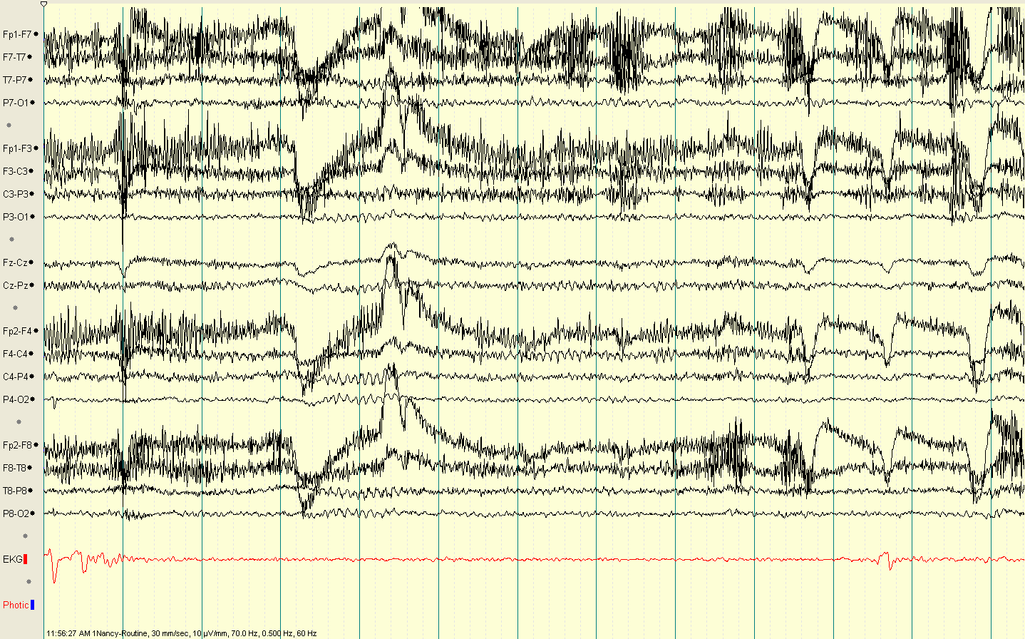 EEG showing Mu rhythm at C3 and C4 electrodes with characteristic comb-like morphology
