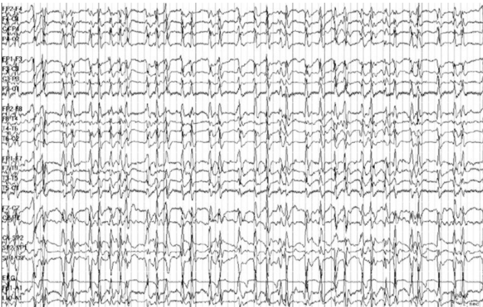 EEG showing Generalized Periodic Discharges (GPDs)