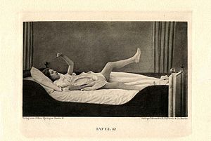 납굴증(Waxy flexibility)을 보이는 환자의 모습. 환자의 팔을 특정 자세로 움직여 놓으면 마치 밀랍 인형처럼 그 자세를 장시간 유지하는 긴장증(Catatonia)의 특징적인 소견을 보여줌.