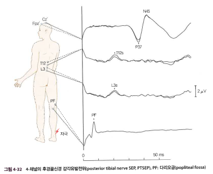 하지 체성감각 유발전위(PTSEP) 파형도