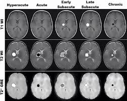뇌출혈 시기별 MRI 신호 변화표