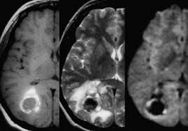 뇌 MRI 영상