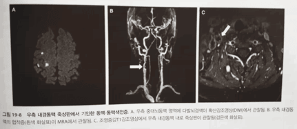 뇌 MRA 및 DWI 영상. MRA에서 우측 속목동맥(ICA) 기부의 심한 협착이 관찰되며, DWI에서 우측 대뇌 반구 피질에 다발성 고신호강도 병변이 산재해 있음.