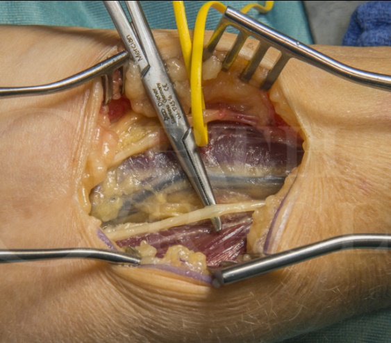 절개 후 노출된 종아리신경(sural nerve) 사진