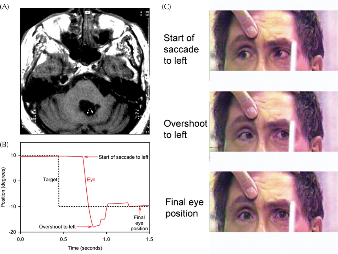 꼭지핵(Fastigial nucleus) 손상 환자의 수평 신속보기 기록. 목표 지점을 초과하는 Hypermetria와 이를 교정하는 Saccade를 보여주는 MRI 및 안구 운동 그래프.