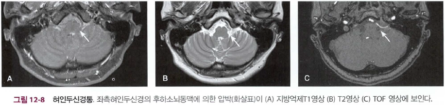 MRI series demonstrating neurovascular compression of the glossopharyngeal nerve by a vascular loop, likely the PICA.