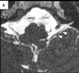 MRI Axial T2-weighted image showing the relationship between the glossopharyngeal nerve and adjacent vascular structures in the cerebellopontine angle cistern.