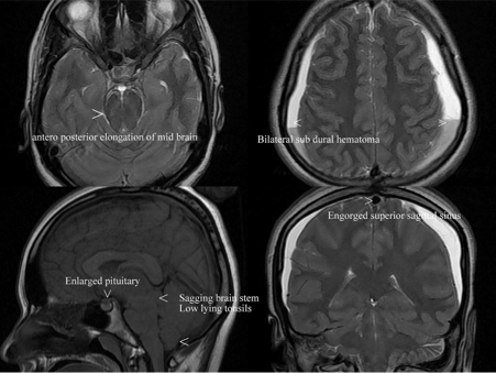 뇌 MRI 시상면 영상. 뇌하수체 비대와 뇌하강 소견이 관찰됨.