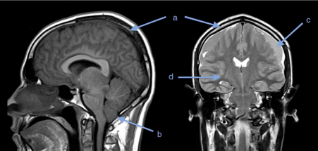 뇌 MRI 시상면 영상. 소뇌 편도가 대공 아래로 하강된 모습과 정맥동 팽창이 관찰됨.
