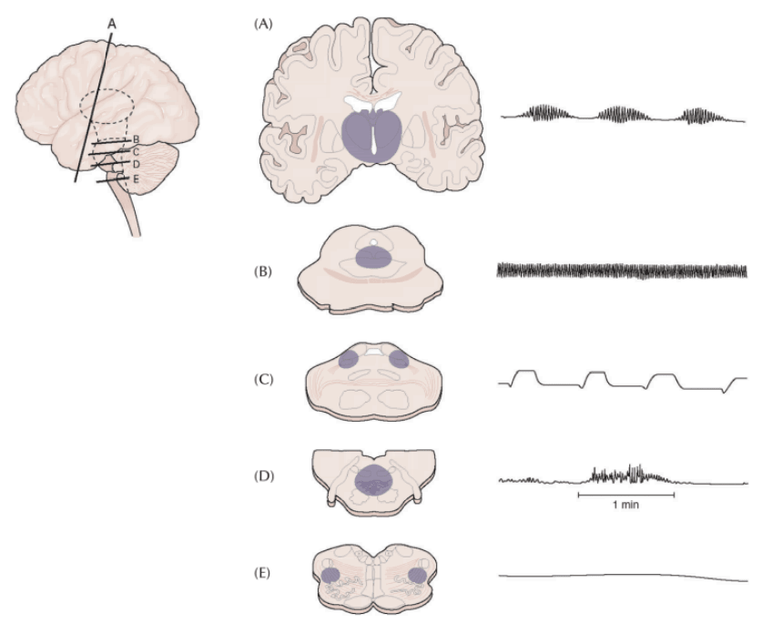 Plum and Posner's breathing patterns
