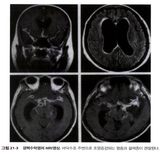 ADA 검사의 진단적 가치 그래프: 결핵 수막염에서 ADA 상승의 유의성 설명.