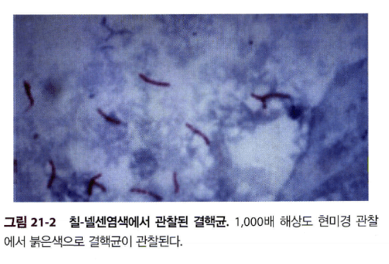 뇌 MRI 예시: Basal meningeal enhancement 및 Tuberculoma 소견.