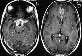 뇌 MRI T1 강조 조영증강 영상: Sylvian fissure와 기저조 부근에 다발성 림 조영증강 병변(Rim-enhancing lesions) 및 수막 조영증강 소견이 관찰됨.