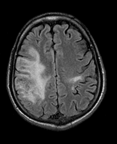 MRI T2/FLAIR Axial: 양측 대뇌 반구의 피질하 백질에 광범위하고 비대칭적인 고신호강도 병변이 관찰됨.