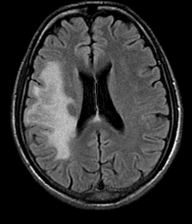 MRI T2/FLAIR Axial: 전두엽 및 두정엽 백질을 중심으로 경계가 불분명한 융합성 병변이 확인됨.
