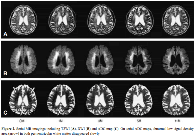 뇌 MRI T2 강조 영상 또는 FLAIR 영상으로 추정되며, 양측 창백핵(globus pallidus) 부위에 대칭적인 고신호강도 병변이 관찰됨. 또한 전두엽을 중심으로 광범위한 대뇌 백질의 신호 강도 변화가 동반되어 일산화탄소 중독에 의한 지연성 뇌병증 소견을 시사함.