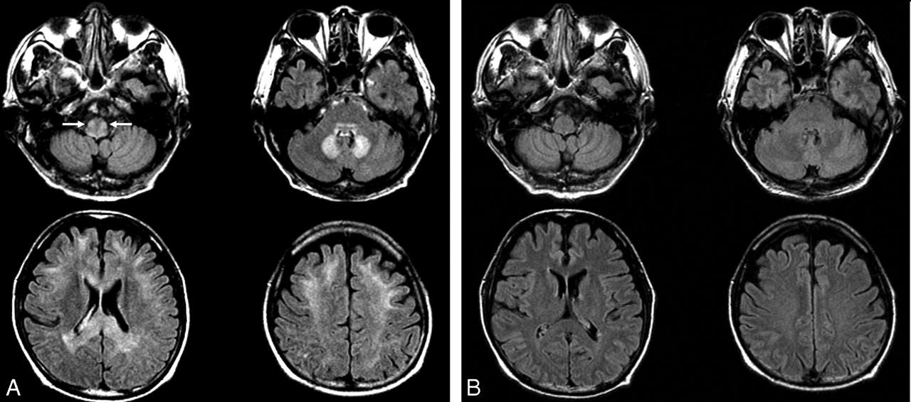 MRI Axial T2/FLAIR
