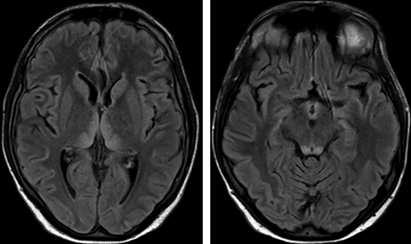 Brain MRI