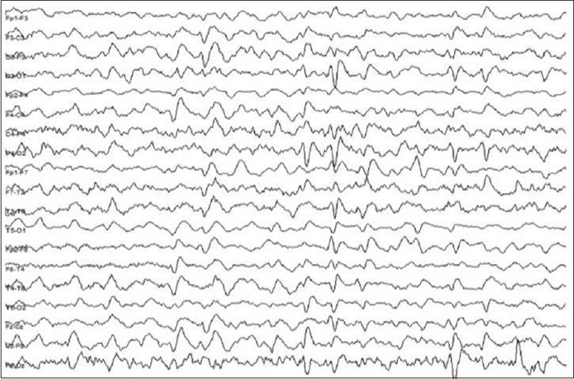 Figure 1: EEG showing generalized periodic discharges with triphasic morphology, characterized by a prominent positive deflection followed by a smaller negative wave, typical of metabolic encephalopathy.