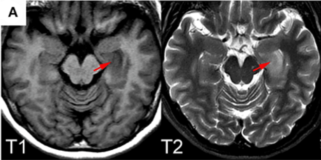 MRI axial FLAIR: Left medial temporal lobe hyperintensity