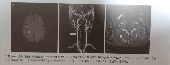 뇌 MRI 확산강조영상(DWI): 양측 중대뇌동맥 영역에 다발성 고신호강도의 급성 뇌경색 소견이 보임