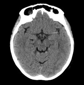 Brain CT (Axial): 좌측 중대뇌동맥(MCA) 부위에 고음영의 혈전 소견(Hyperdense MCA sign)이 관찰됨.