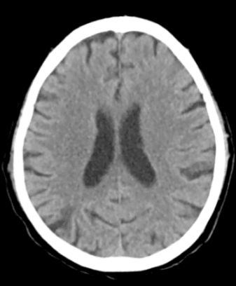 Brain CT (Axial): 측뇌실(Lateral ventricle) 높이의 단면으로, 뚜렷한 뇌출혈이나 광범위한 저음영 변화는 보이지 않음.