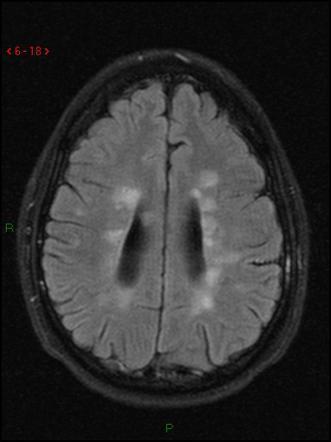 3개월 후 MRI - 뇌실 벽에서 수직으로 뻗어 나가는 Dawson fingers 양상의 병변