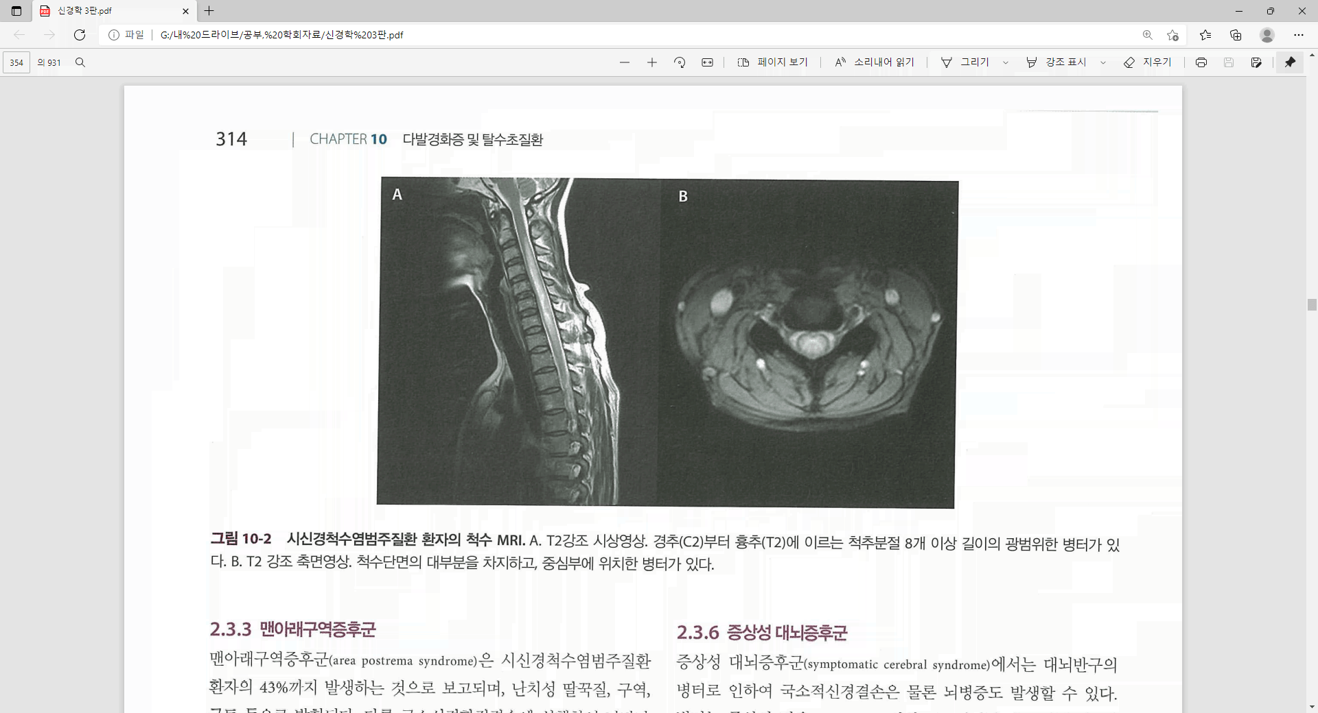 C-spine MRI T2 sagittal view: 3개 이상의 척추체를 침범하는 고신호강도의 긴 가로척수염(LETM) 소견