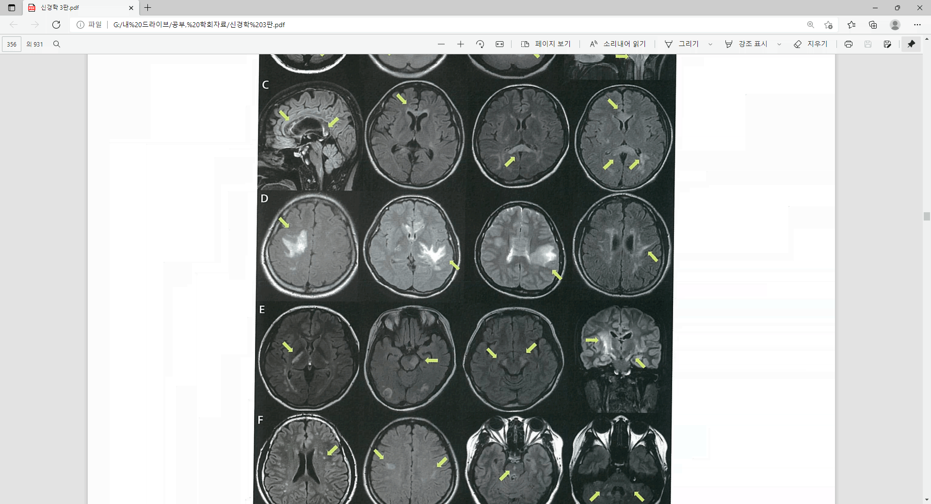 Brain MRI FLAIR axial view: 뇌량(corpus callosum) 및 양측 속섬유막(internal capsule) 부위의 고신호강도 병변