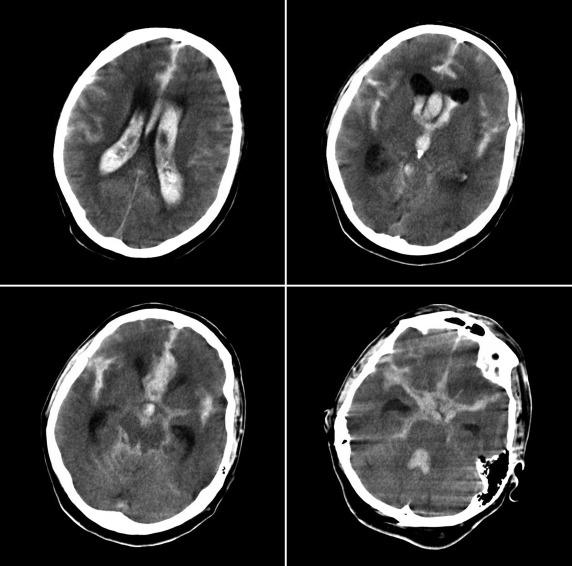 Brain CT showing SAH and IVH