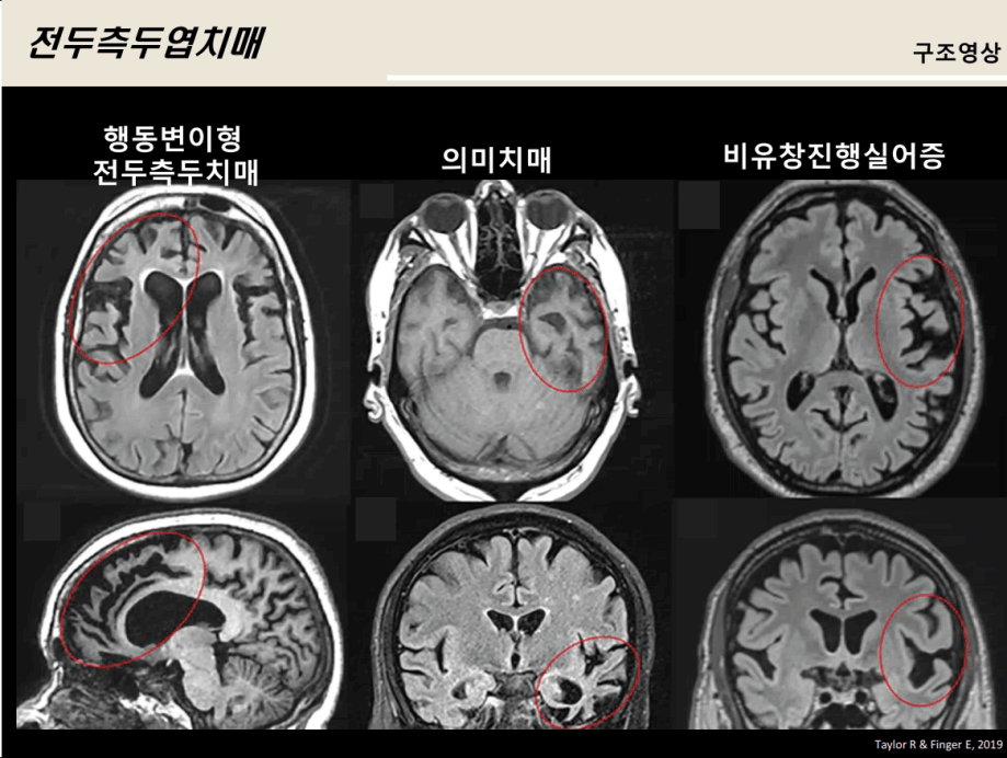 Differential diagnosis of PPA
