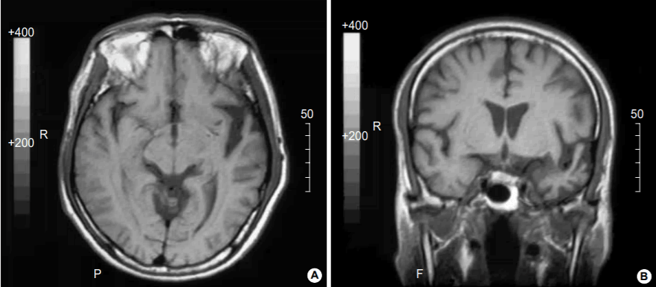 Brain MRI showing anterior temporal atrophy