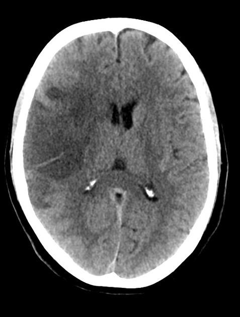 뇌 CT: 우측 중간뇌동맥(MCA) 영역에 광범위한 저음영(hypodensity)과 뇌부종으로 인한 정중선 변위(midline shift)가 관찰되는 악성 MCA 경색 소견