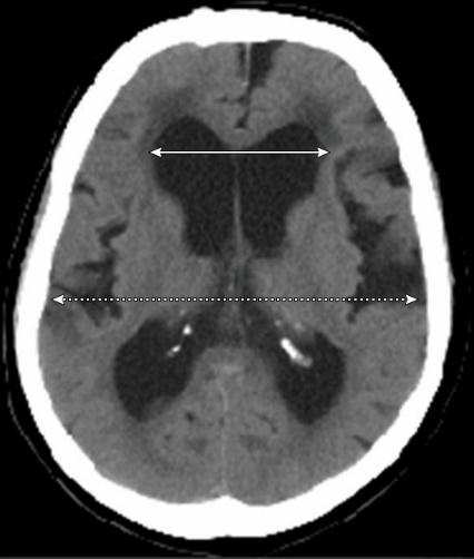 Evans ratio 측정법: Frontal horn diameter / Skull diameter