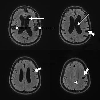 뇌실 확장과 뇌척수액 흐름 정체를 보여주는 MRI 증례