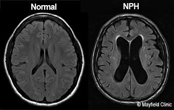 뇌 MRI 축상면 T2 강조영상에서 뇌실이 현저히 확장되어 있으며, 실비우스열이 넓어져 있는 소견
