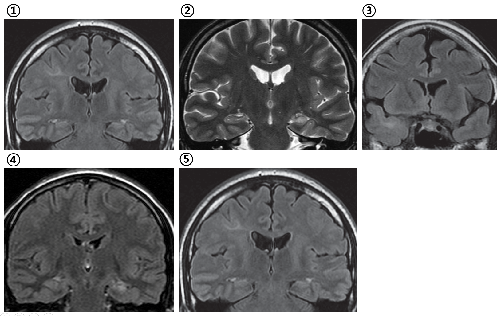 MRI Coronal images showing various epileptogenic lesions