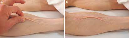 피부 사진: 손등 피부를 잡아당겼을 때 즉시 복원되지 않고 주름이 유지되는 skin turgor 저하 소견.