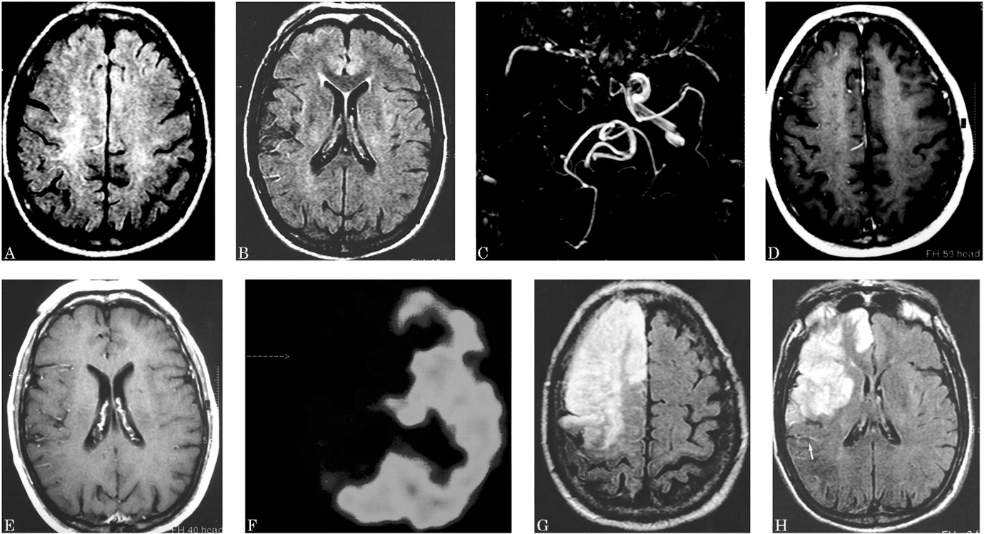Comparison of FLAIR HVS and other vascular findings.