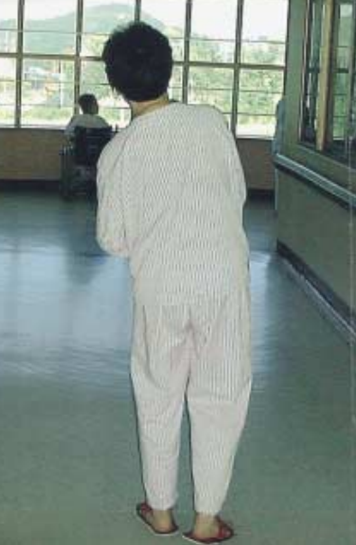 Galantamine 복용 시 몸이 기울어진 모습과 Memantine 변경 후 곧게 펴진 모습의 비교 사진