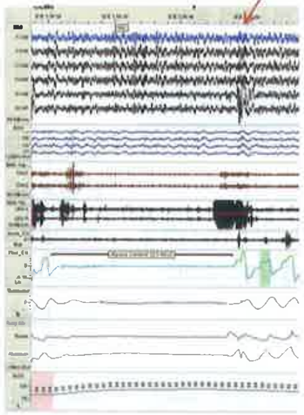 PSG_Leg_EMG