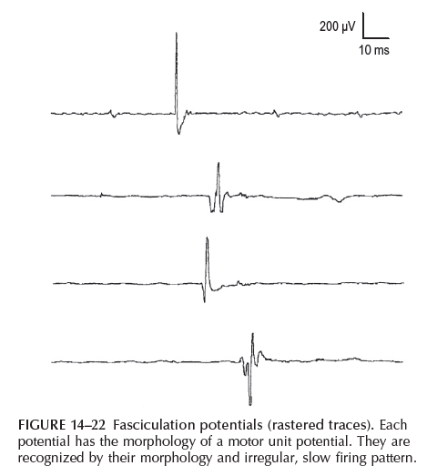 Fasciculation Potential 파형 예시