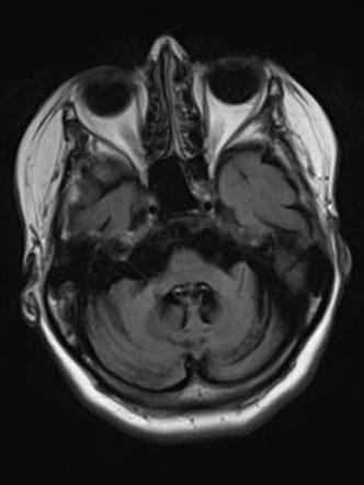 MRI