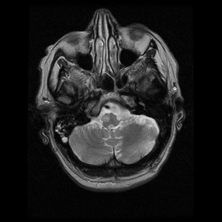 Hypertrophic olivary degeneration