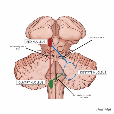 Guillain-Mollaret triangle diagram