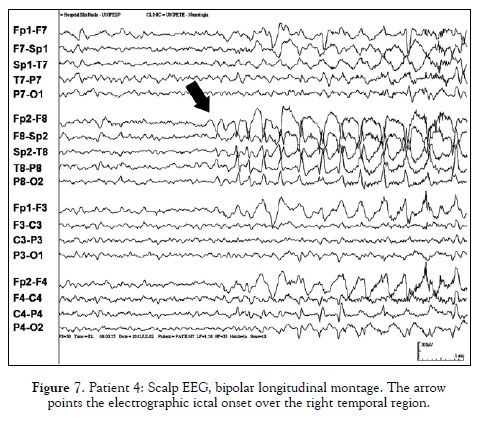 EEG 소견: 우측 전측두부(F8, Sp2) 전극에서 기원하는 극파(spike) 및 예파 관찰