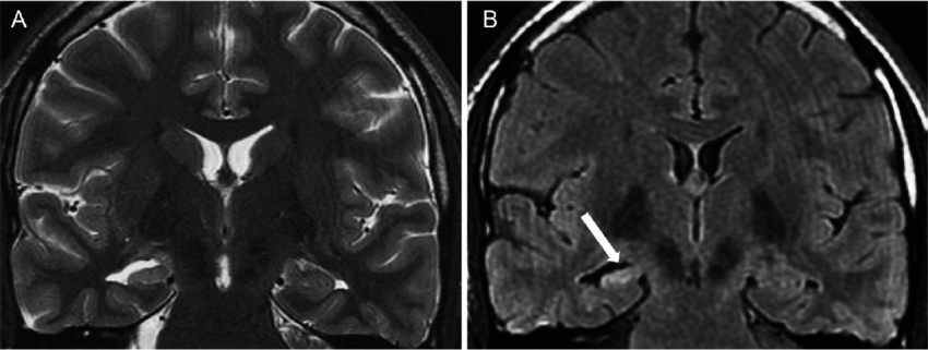 Brain MRI(Coronal T2/FLAIR): 우측 해마의 위축 및 고신호강도 소견(해마 경화증)
